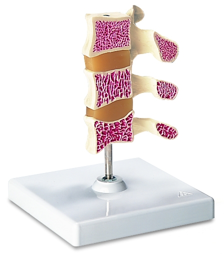 Osteoporose 3 stadia